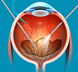 eye showing internal structure and medical instruments being used inside the middle of the eye