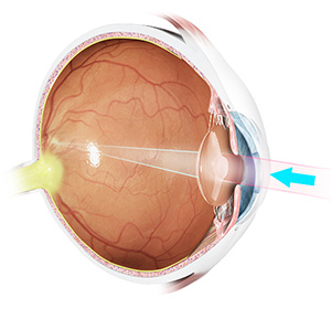 internal image of eye showing beam of light going through to the retina