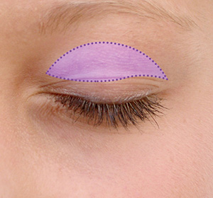 closed eye with an outline drawn by a surgeon showing where the operation will occur.