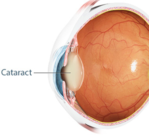 eye showing internal structure and where the location of the cataract is.