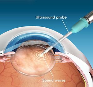 Eye undergoing cataract surgery with the use of an ultrasound probe and effects of sound waves being seen