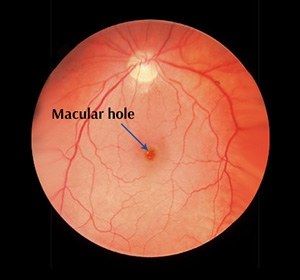 internal image of eye showing macular hole