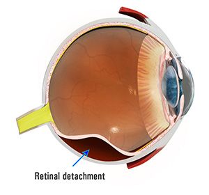 internal image of eye with a label showing retinal detachment.