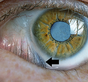 image showing inverting of the lower lid eyelashes