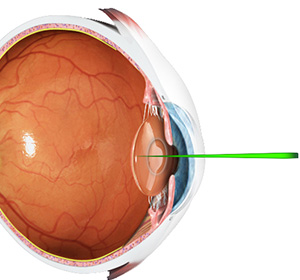 Image of eye structure with a needle going through lens and cornea.