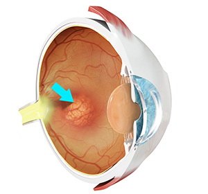 dissected eye showing internal structure with the retina being highlighted.