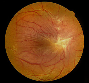 internal image of an eye showing the blood vessels
