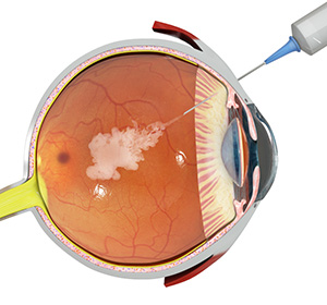 eye showing internal structure and a needle injecting a medicine inside the middle of the eye