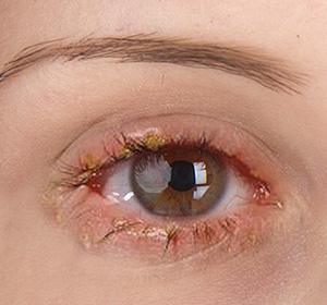 Close up of an eye showing a severe case of blepharitis