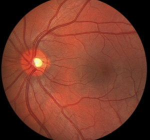 Image showing the inside of an eye for macular hole condition.