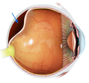 Image of eye structure with an arrow pointing to a detached retina